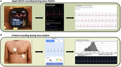 Frontiers | Remote Cardiac Rhythm Monitoring in the Era of Smart